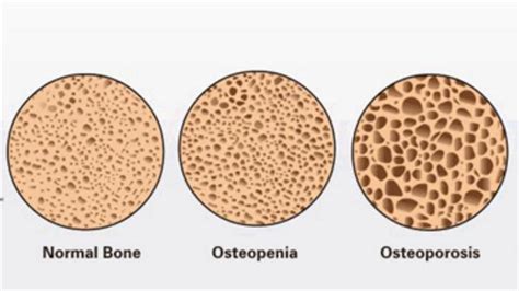 osteopenia é grave - o que é função